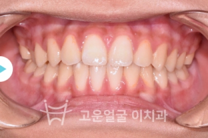 치료후기 이미지